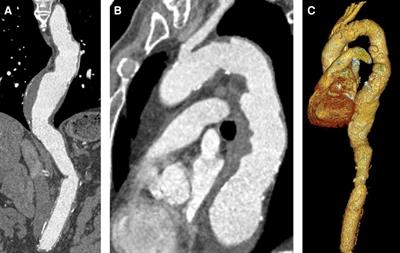 Case Report: Successful endovascular treatment of acute type A aortic dissection